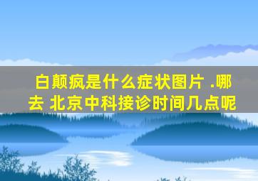 白颠疯是什么症状图片 .哪去 北京中科接诊时间几点呢
